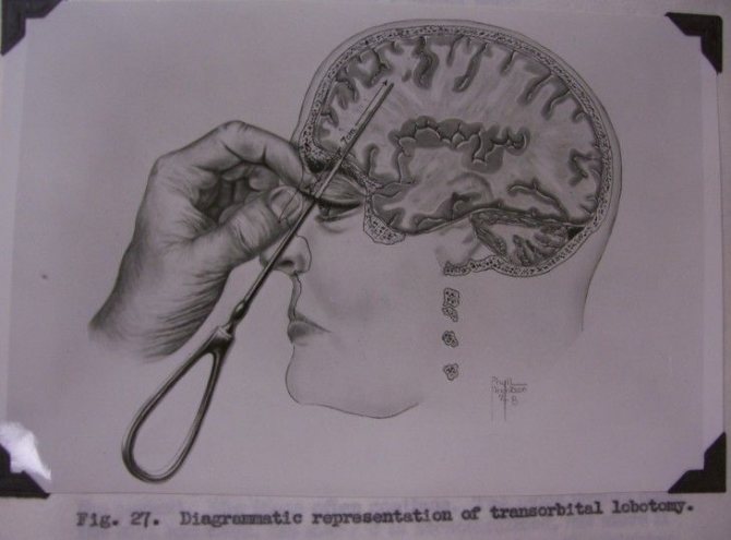8 Chilling Facts About Lobotomy (7 Photos)