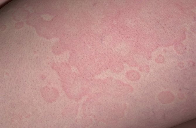 Аллергия на нервной почве на лице