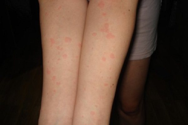 Аллергия от стресса — Аллергия