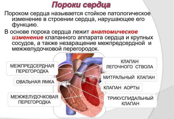 Что такое порок сердца