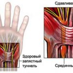 Долгие и однообразные нагрузках на руки,приводят к туннельному синдрому