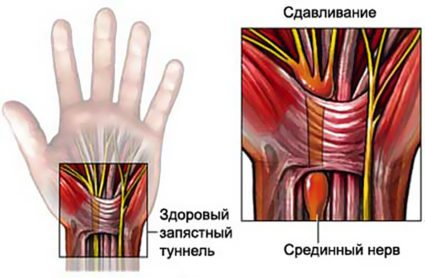 Долгие и однообразные нагрузках на руки,приводят к туннельному синдрому