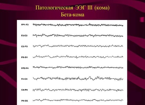 EEG is a mandatory procedure for patients in coma