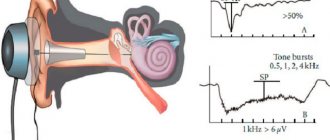 Электрокохлеография слухового нерва