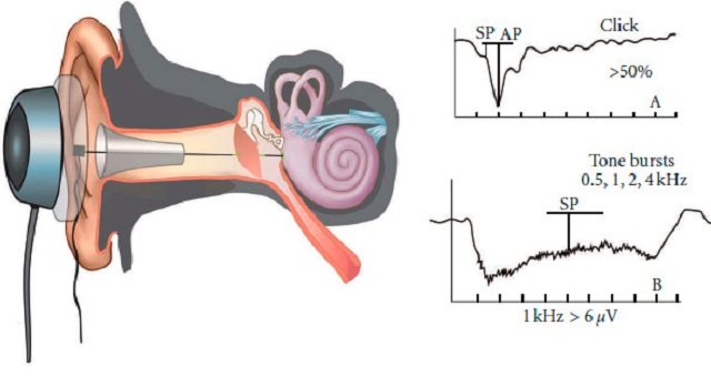 Электрокохлеография слухового нерва