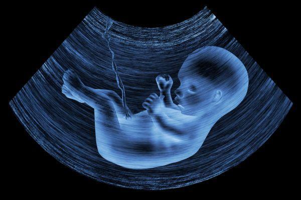 Fetal hydrocephalus on ultrasound