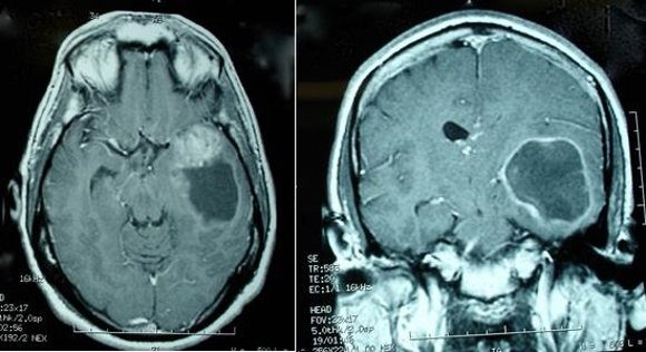 Глиобластома - опасное злокачественное новообразование головного мозга