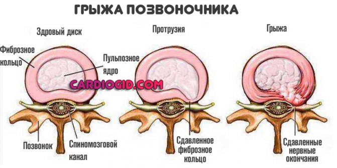spinal hernia