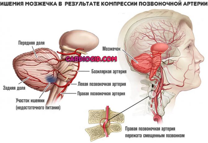 cerebellar ischemia-resulting-osteochondrosis