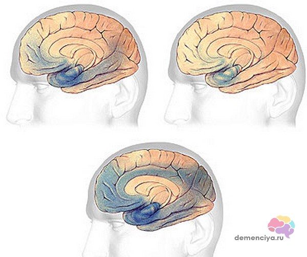 Изменения в головном мозге при заболевании деменцией