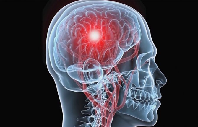 как болит голова при опухоли головного мозга