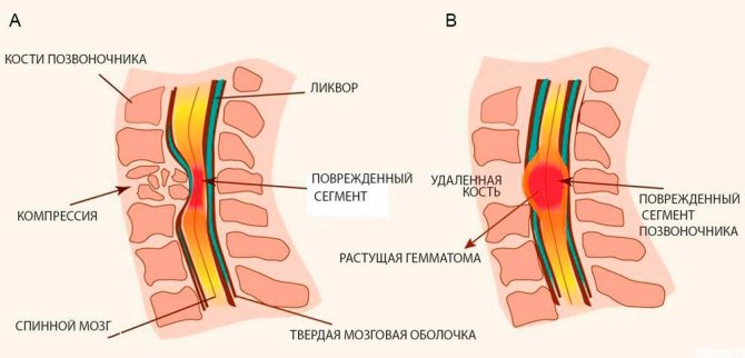 Spinal cord compression