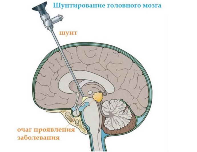 lateroventriculoasymmetry of the brain therapy