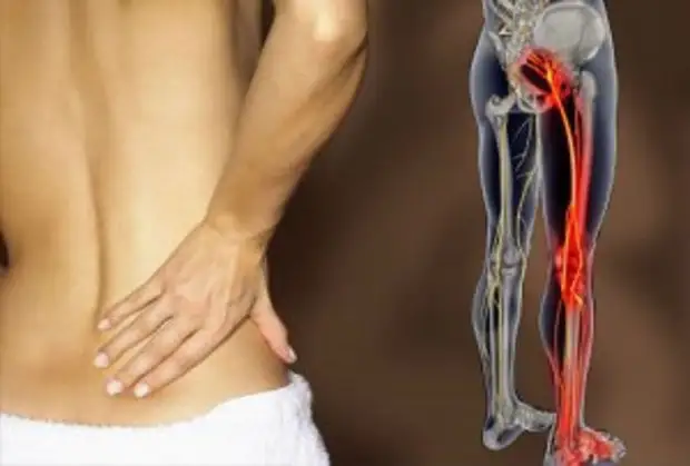 Treatment of the sciatic nerve with folk remedies
