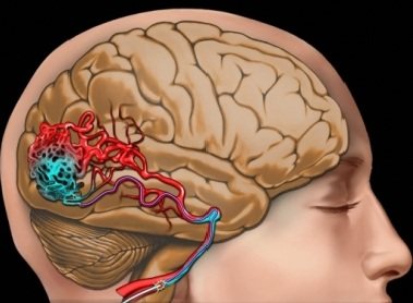 Мальформация сосудов головного мозга: причины, симптомы и лечение