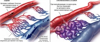 Мальформация сосудов головного мозга: симптомы, лечение