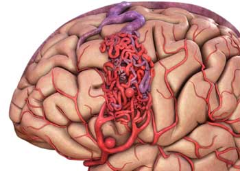 Malformation of cerebral vessels: symptoms, treatment