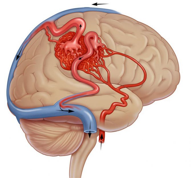 Мальформация сосудов головного мозга: симптомы, лечение