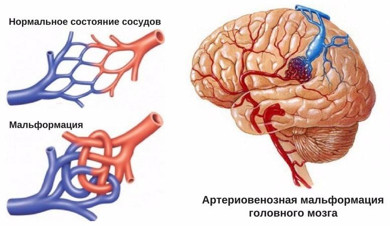 Malformation of cerebral vessels: symptoms, treatment