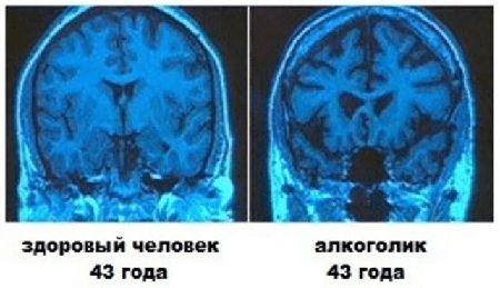мозг алкоголика и здорового человека