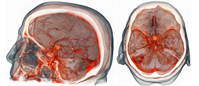 МР ангиография сосудов головного мозга