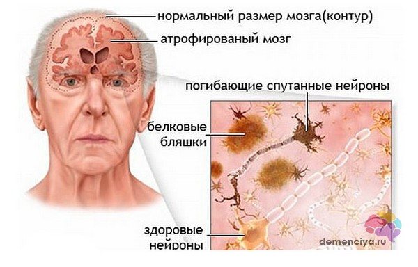 Multiple system atrophy in Parkinson&#39;s disease