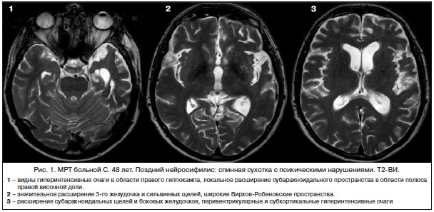 Neurosyphilis consequence