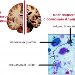 Нормальный нейрон и пораженный при болезни Альцгеймера