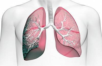 Lung lesion