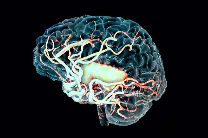 Очаговые изменения вещества мозга дисциркуляторного и дистрофического характера