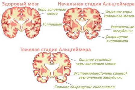 Причины болезни Альцгеймера, лечение