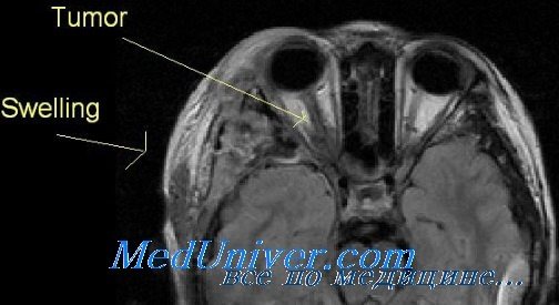 Признаки невриномы, нейрофибромы, менингиомы глаза на КТ