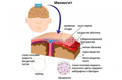 Development of viral meningitis