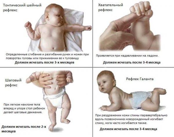 Newborn reflexes are normal