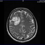 X-ray of a brain cyst