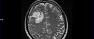 рентген кисты головного мозга