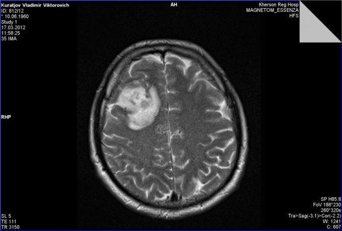 рентген кисты головного мозга