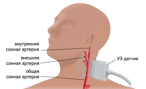 Scanning of the brachiocephalic arteries