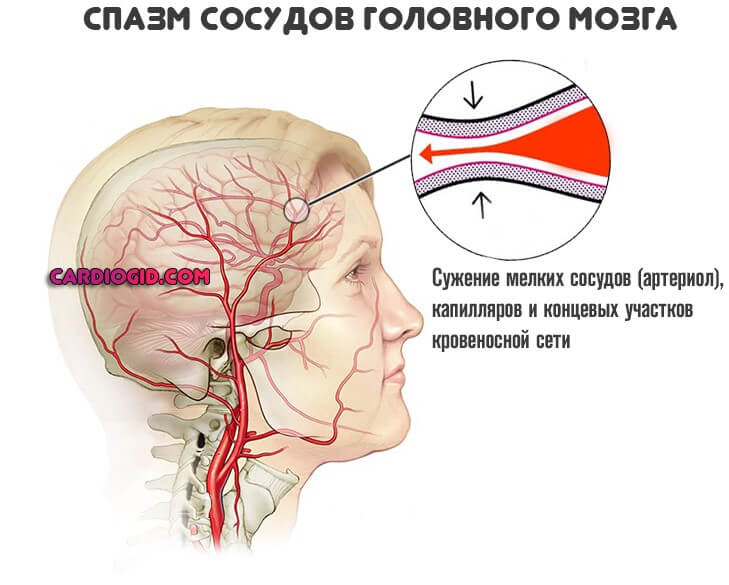 cerebral vasospasm
