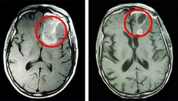 This is what glioblastoma looks like in the picture