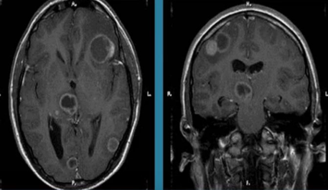 Toxoplasmosis on MRI of the brain
