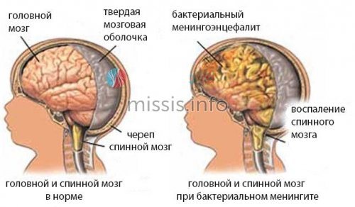 Inflammation of the brain